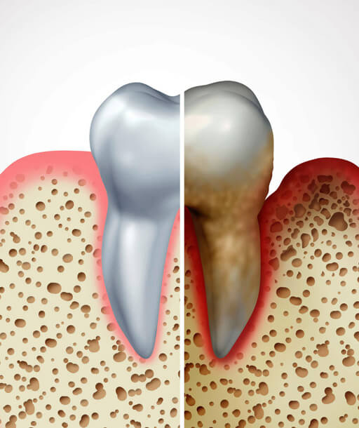 Healthy vs infected tooth showing need for root canal treatment