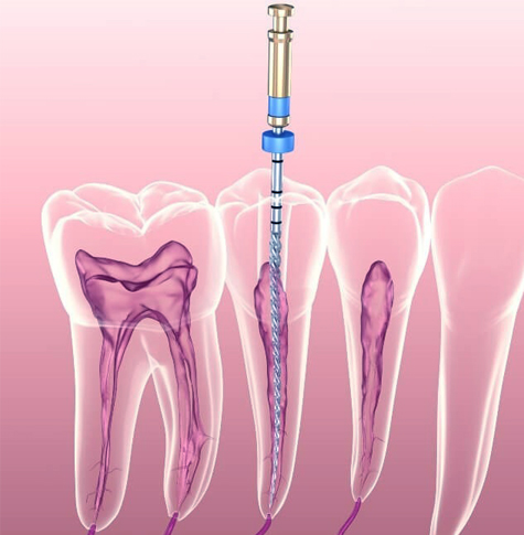 can you smoke a cigarette after a root canal Can I Smoke After Root Canal Treatment? Risks & Tips
