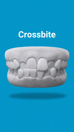 3D dental model showing crossbite malocclusion against blue background for Cottonwood Dental educational content.