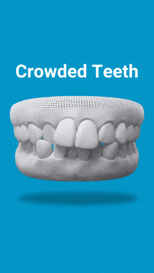 3D dental model displaying crowded teeth condition against blue background with label.