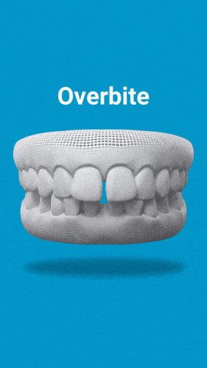 Dental model displaying overbite malocclusion on blue background for educational purposes.